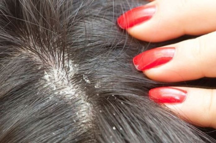 Easy and Effective Home Remedies for Dandruff Removal